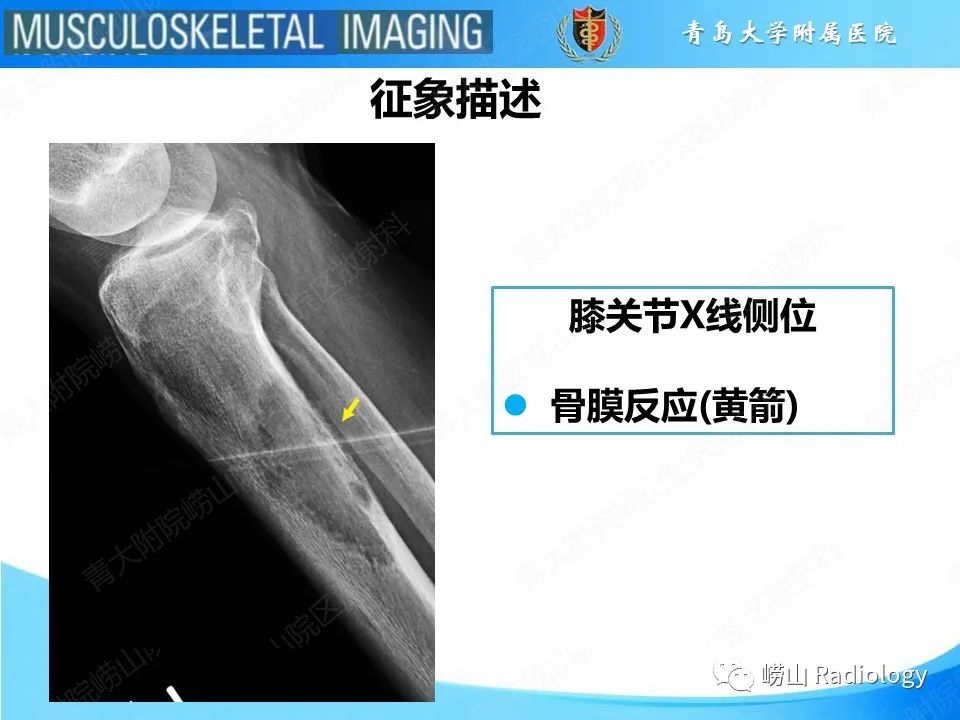 影像PPT - 【PPT】溶骨性骨质破坏-14