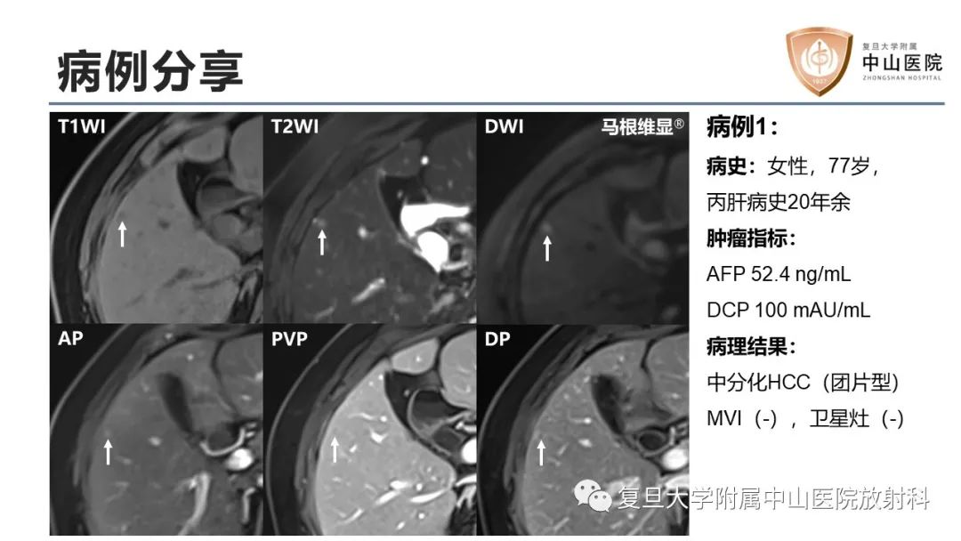 影像PPT - 【病例】微小肝癌1例MR影像-15
