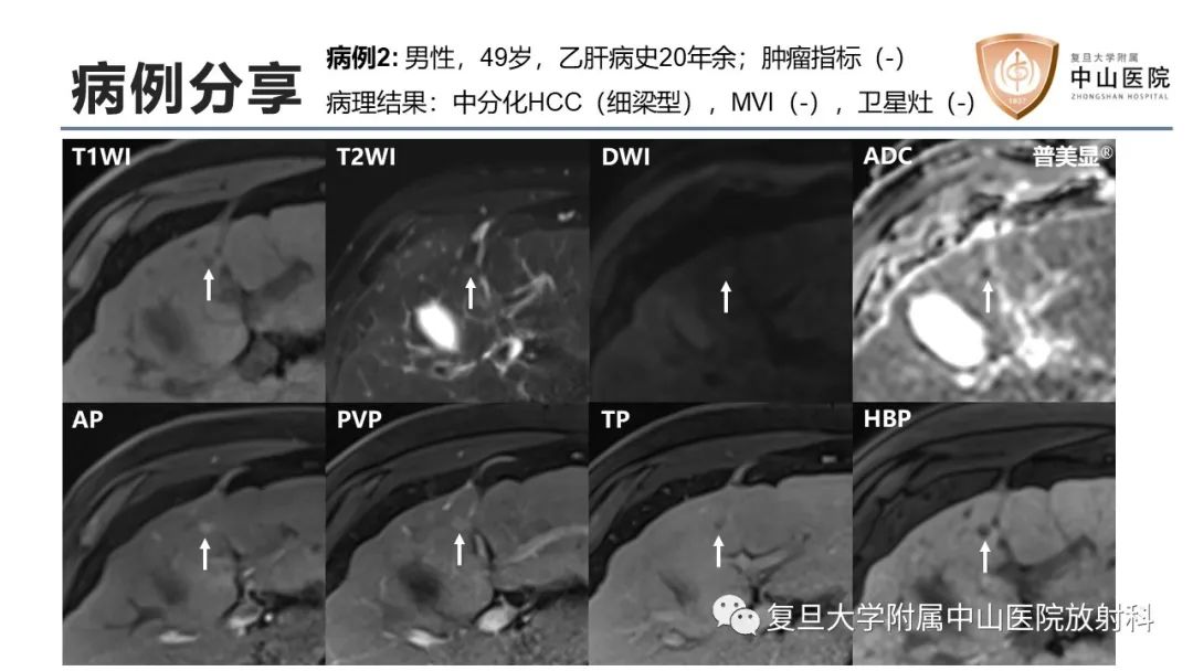 影像PPT - 【病例】微小肝癌1例MR影像-16