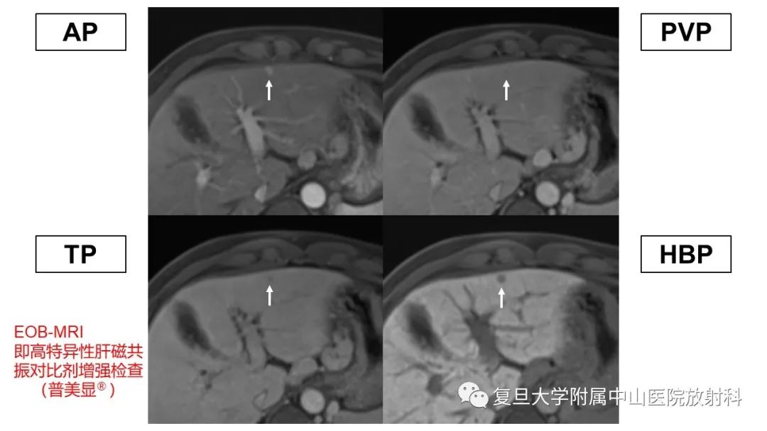 影像PPT - 【病例】微小肝癌1例MR影像-4
