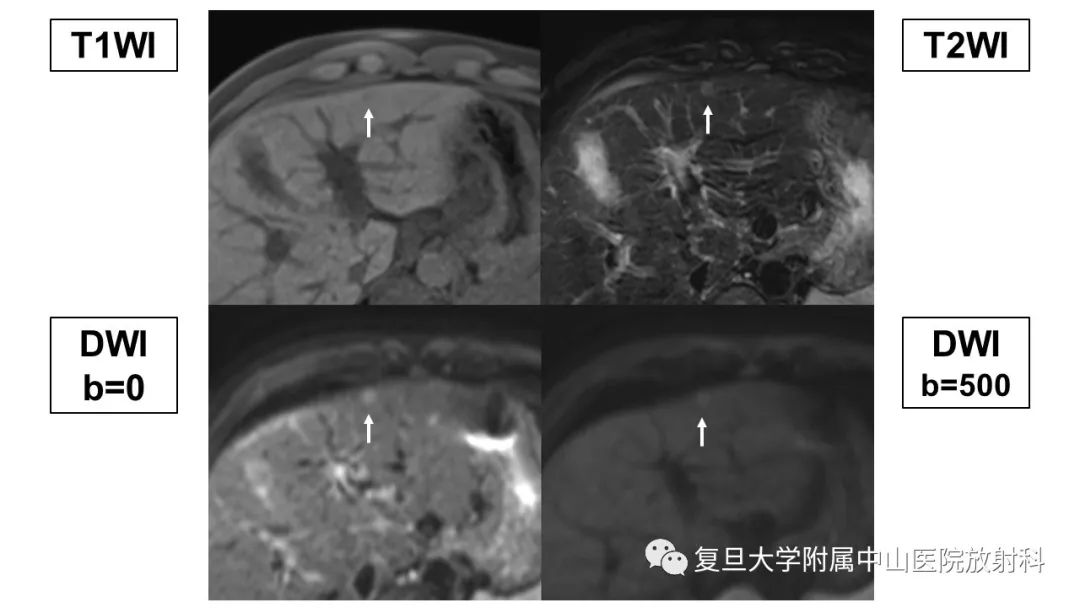影像PPT - 【病例】微小肝癌1例MR影像-3