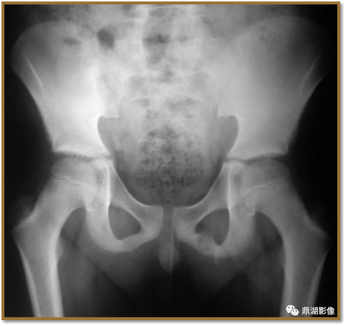 影像PPT - 【病例】耻坐骨软骨联合不对称1例X线-1 影像PPT - 【病例】耻坐骨软骨联合不对称1例X线-1