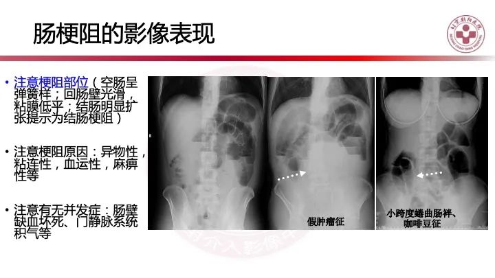 影像PPT - 【PPT】急性弥漫性腹痛-肠梗阻-4