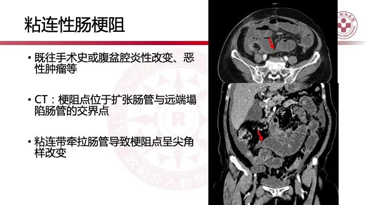 影像PPT - 【PPT】急性弥漫性腹痛-肠梗阻-5