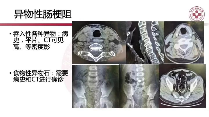 影像PPT - 【PPT】急性弥漫性腹痛-肠梗阻-6