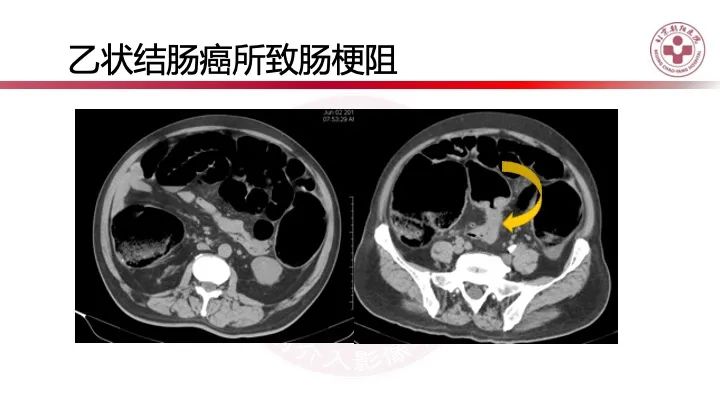影像PPT - 【PPT】急性弥漫性腹痛-肠梗阻-8
