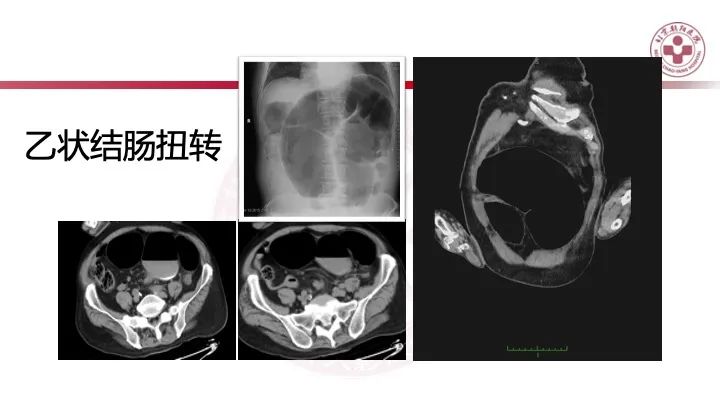 影像PPT - 【PPT】急性弥漫性腹痛-肠梗阻-9