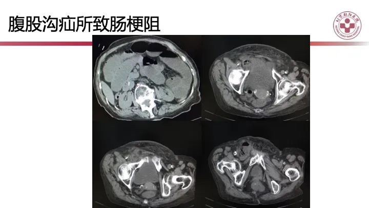 影像PPT - 【PPT】急性弥漫性腹痛-肠梗阻-12