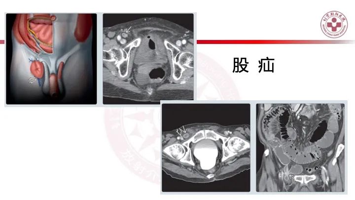 影像PPT - 【PPT】急性弥漫性腹痛-肠梗阻-13