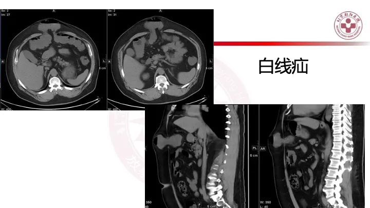 影像PPT - 【PPT】急性弥漫性腹痛-肠梗阻-18