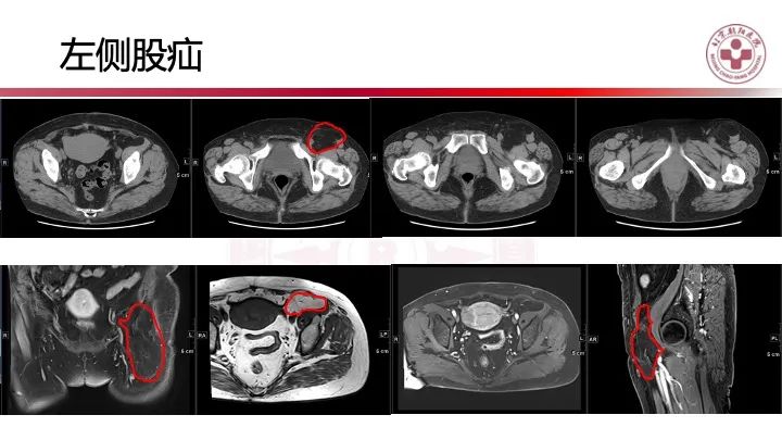 影像PPT - 【PPT】急性弥漫性腹痛-肠梗阻-14