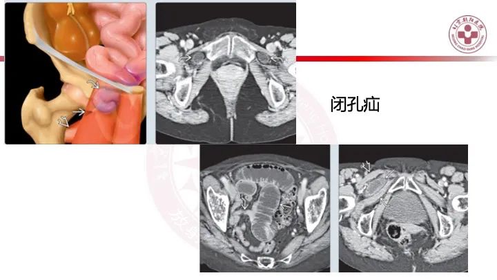 影像PPT - 【PPT】急性弥漫性腹痛-肠梗阻-19