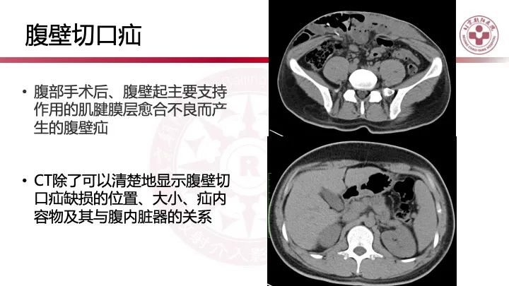 影像PPT - 【PPT】急性弥漫性腹痛-肠梗阻-15