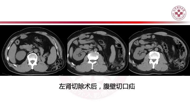 影像PPT - 【PPT】急性弥漫性腹痛-肠梗阻-16