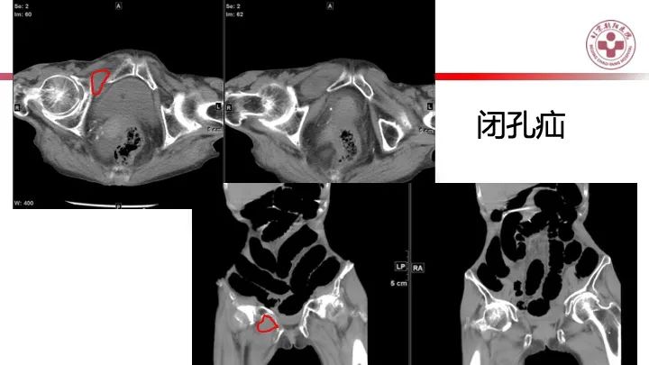 影像PPT - 【PPT】急性弥漫性腹痛-肠梗阻-20