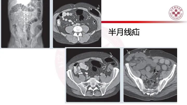 影像PPT - 【PPT】急性弥漫性腹痛-肠梗阻-21
