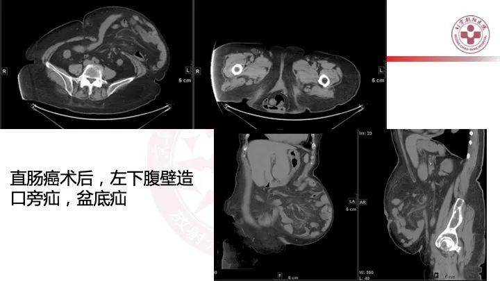 影像PPT - 【PPT】急性弥漫性腹痛-肠梗阻-23