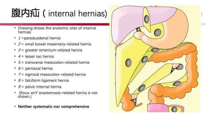 影像PPT - 【PPT】急性弥漫性腹痛-肠梗阻-24