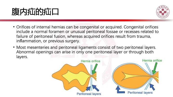 影像PPT - 【PPT】急性弥漫性腹痛-肠梗阻-25