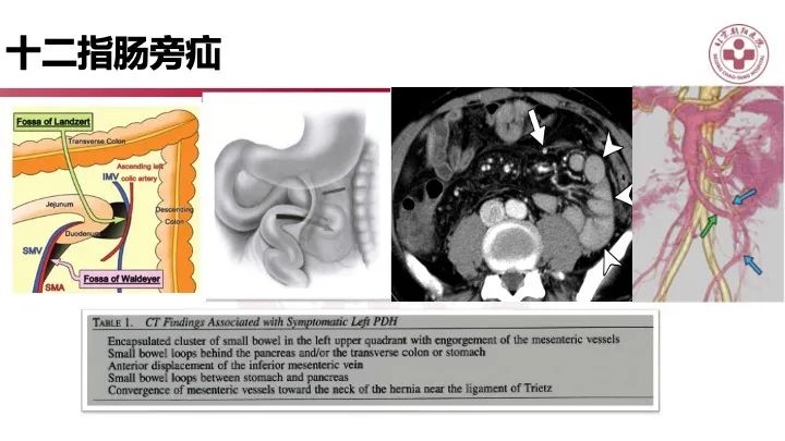 影像PPT - 【PPT】急性弥漫性腹痛-肠梗阻-29