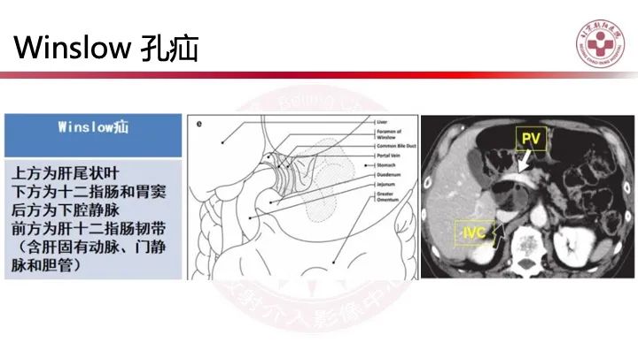 影像PPT - 【PPT】急性弥漫性腹痛-肠梗阻-32