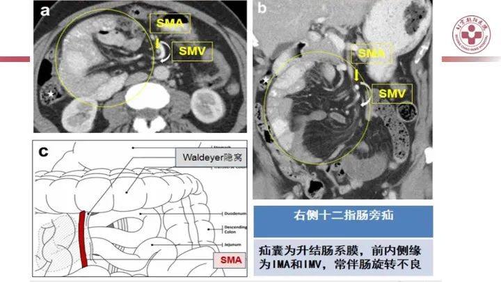影像PPT - 【PPT】急性弥漫性腹痛-肠梗阻-31