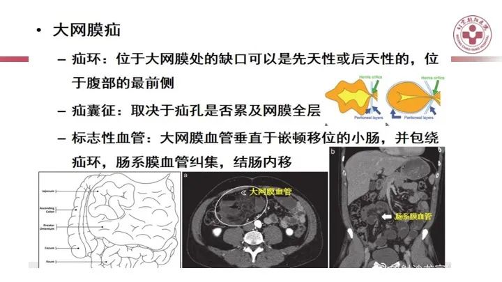 影像PPT - 【PPT】急性弥漫性腹痛-肠梗阻-34