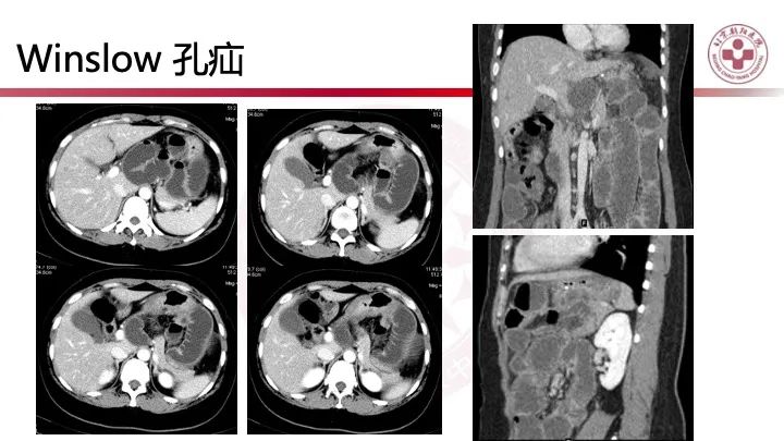 影像PPT - 【PPT】急性弥漫性腹痛-肠梗阻-33