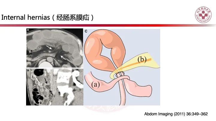 影像PPT - 【PPT】急性弥漫性腹痛-肠梗阻-35