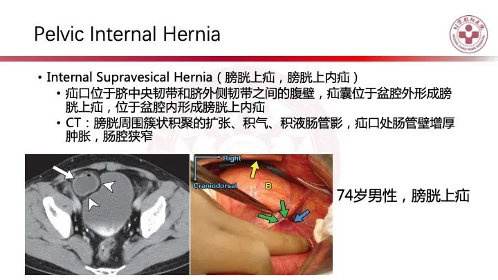 影像PPT - 【PPT】急性弥漫性腹痛-肠梗阻-42