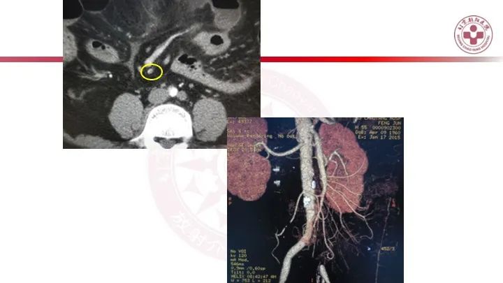 影像PPT - 【PPT】急性弥漫性腹痛-肠梗阻-45