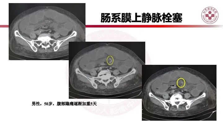 影像PPT - 【PPT】急性弥漫性腹痛-肠梗阻-48