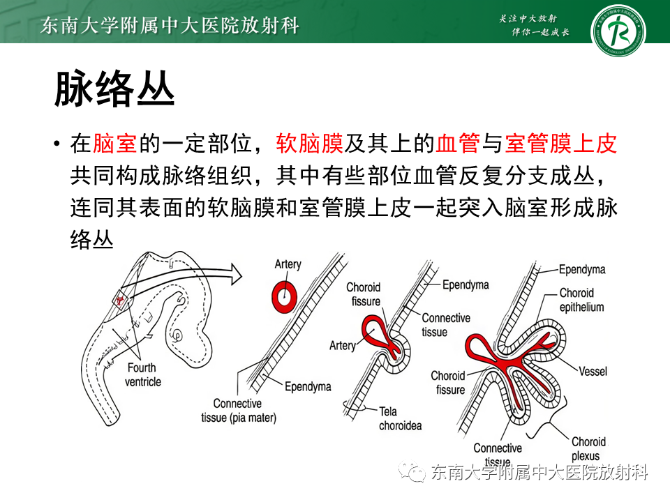 影像PPT - 【PPT】脉络丛乳头状瘤-4 影像PPT - 【PPT】脉络丛乳头状瘤-4