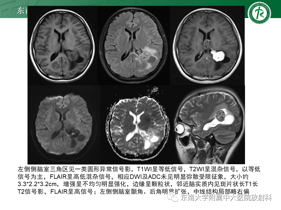 影像PPT - 【PPT】脉络丛乳头状瘤-2 影像PPT - 【PPT】脉络丛乳头状瘤-2