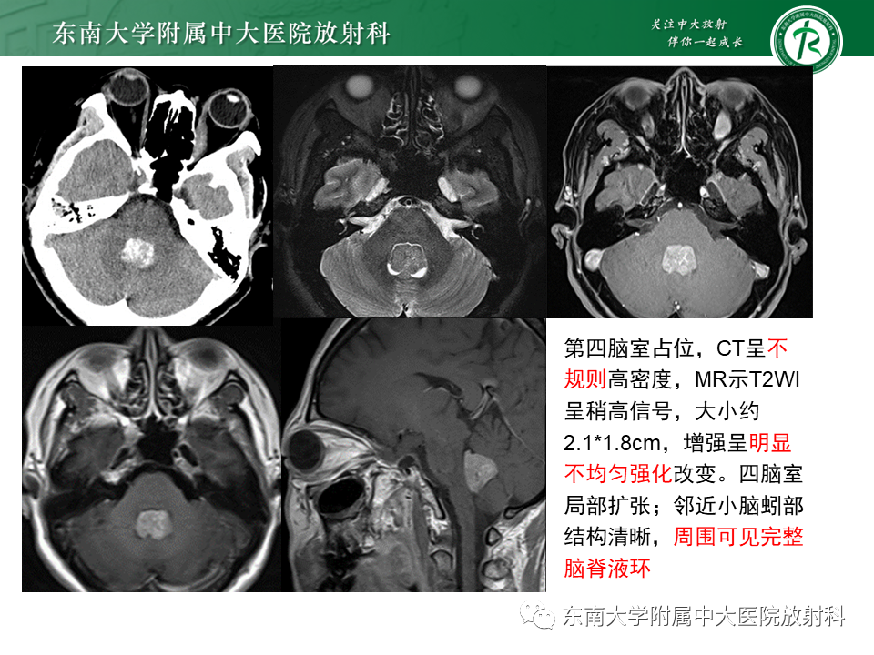 影像PPT - 【PPT】脉络丛乳头状瘤-15 影像PPT - 【PPT】脉络丛乳头状瘤-15