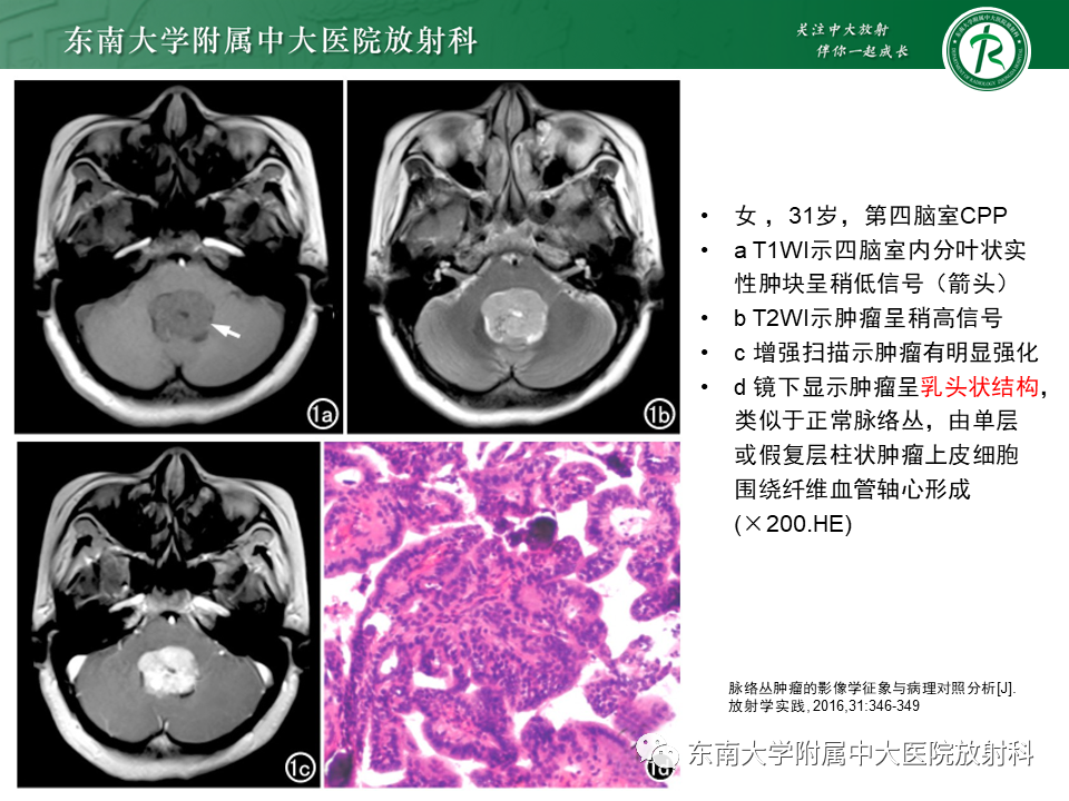 影像PPT - 【PPT】脉络丛乳头状瘤-18 影像PPT - 【PPT】脉络丛乳头状瘤-18