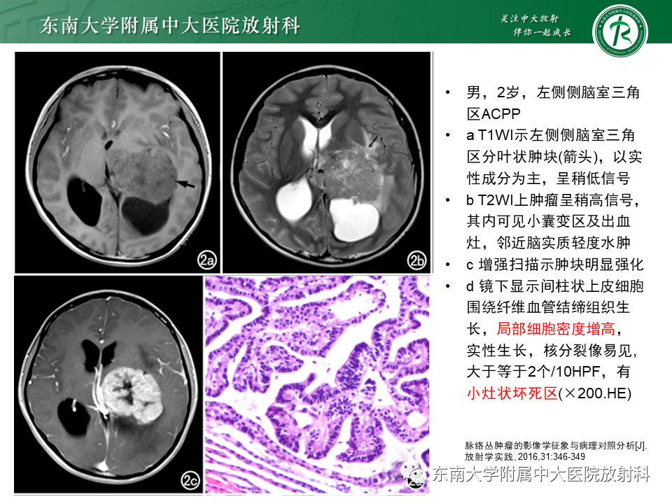 影像PPT - 【PPT】脉络丛乳头状瘤-19 影像PPT - 【PPT】脉络丛乳头状瘤-19