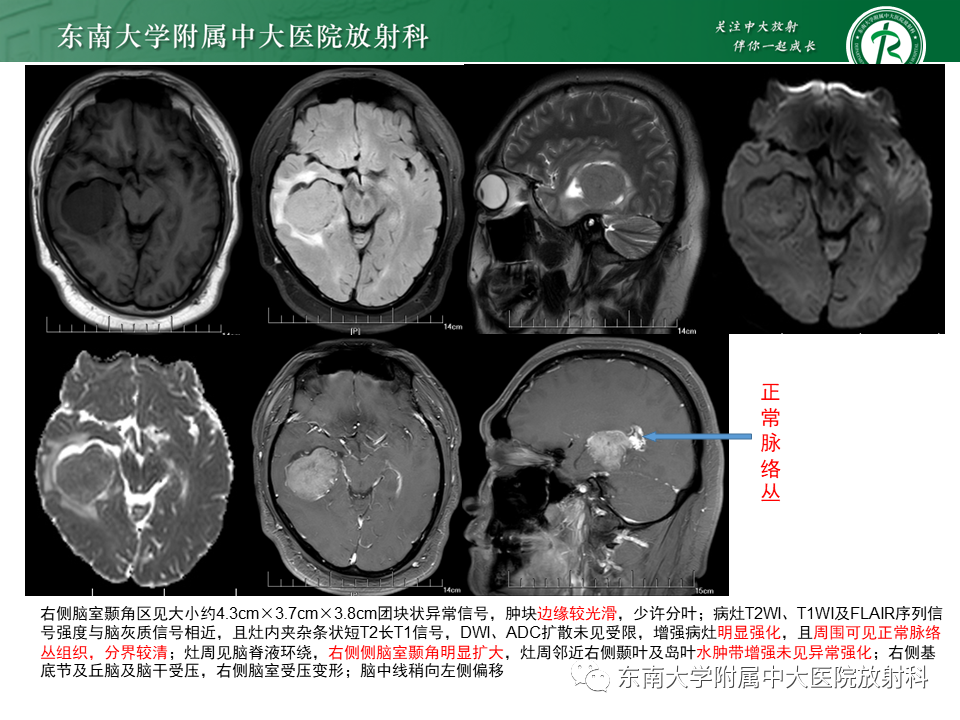 影像PPT - 【PPT】脉络丛乳头状瘤-25 影像PPT - 【PPT】脉络丛乳头状瘤-25