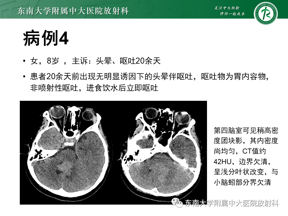 影像PPT - 【PPT】脉络丛乳头状瘤-28 影像PPT - 【PPT】脉络丛乳头状瘤-28