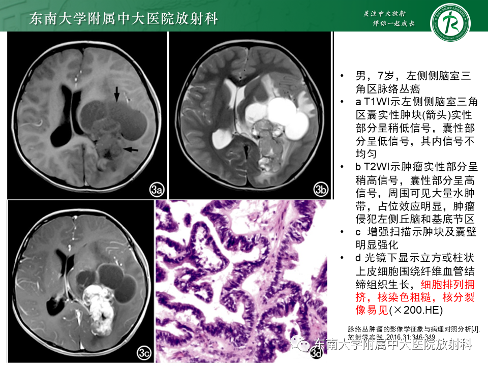 影像PPT - 【PPT】脉络丛乳头状瘤-20 影像PPT - 【PPT】脉络丛乳头状瘤-20
