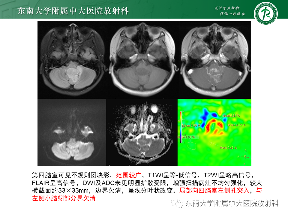 影像PPT - 【PPT】脉络丛乳头状瘤-29 影像PPT - 【PPT】脉络丛乳头状瘤-29