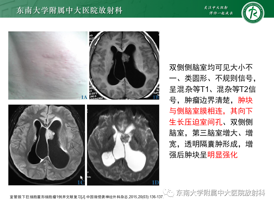 影像PPT - 【PPT】脉络丛乳头状瘤-35 影像PPT - 【PPT】脉络丛乳头状瘤-35