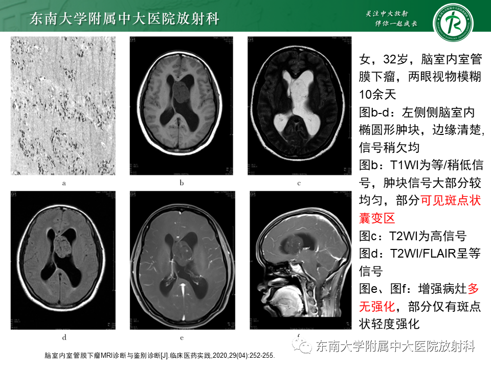 影像PPT - 【PPT】脉络丛乳头状瘤-33 影像PPT - 【PPT】脉络丛乳头状瘤-33