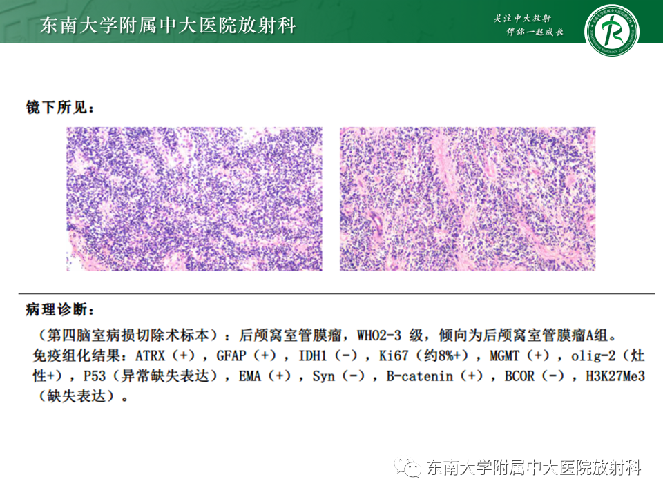 影像PPT - 【PPT】脉络丛乳头状瘤-30 影像PPT - 【PPT】脉络丛乳头状瘤-30