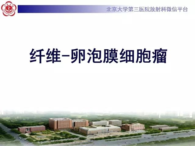 影像PPT - 【病例】纤维卵泡膜细胞瘤1例MR-9