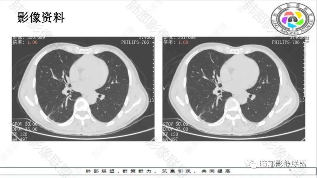 影像PPT - 【病例】最常见的肺部条片影—“尖角”定乾坤-4 影像PPT - 【病例】最常见的肺部条片影—“尖角”定乾坤-4