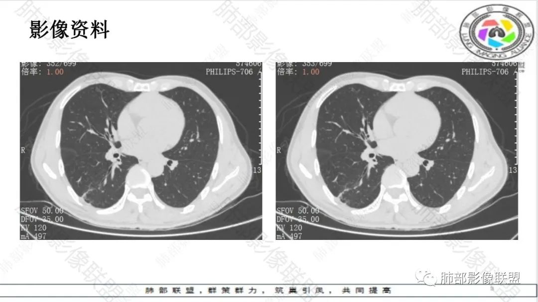 影像PPT - 【病例】最常见的肺部条片影—“尖角”定乾坤-5 影像PPT - 【病例】最常见的肺部条片影—“尖角”定乾坤-5
