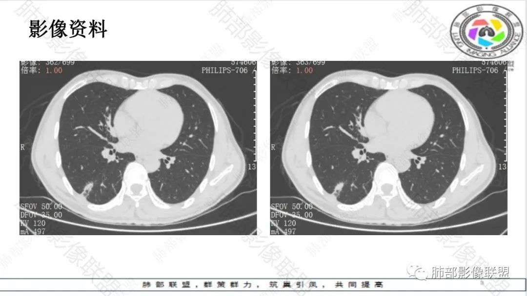 影像PPT - 【病例】最常见的肺部条片影—“尖角”定乾坤-10 影像PPT - 【病例】最常见的肺部条片影—“尖角”定乾坤-10
