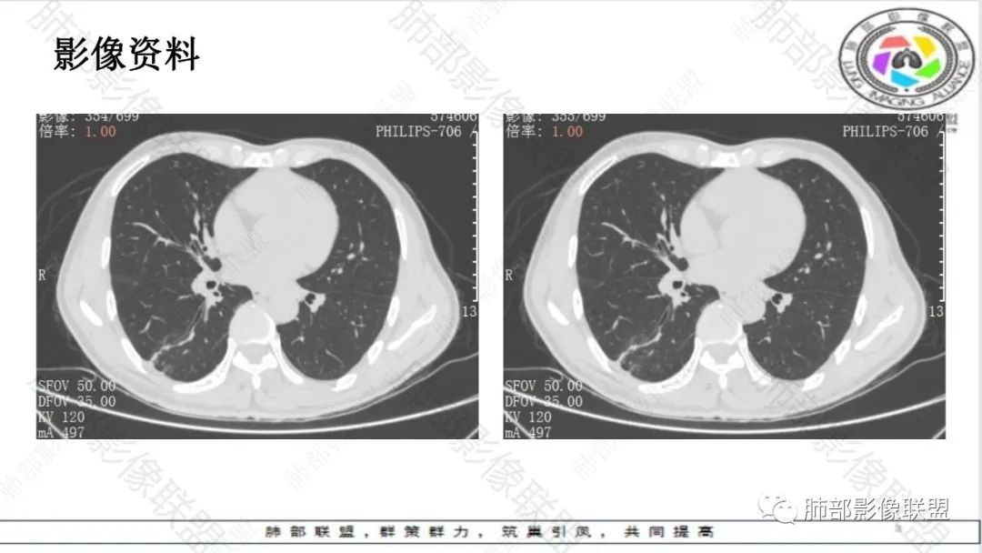 影像PPT - 【病例】最常见的肺部条片影—“尖角”定乾坤-6 影像PPT - 【病例】最常见的肺部条片影—“尖角”定乾坤-6