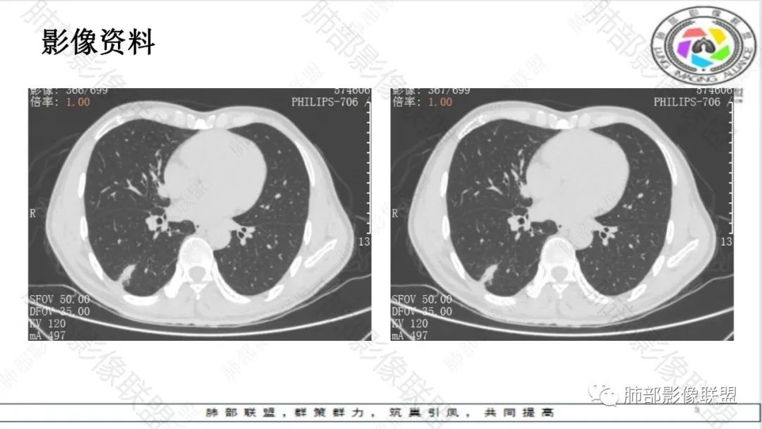 影像PPT - 【病例】最常见的肺部条片影—“尖角”定乾坤-12 影像PPT - 【病例】最常见的肺部条片影—“尖角”定乾坤-12